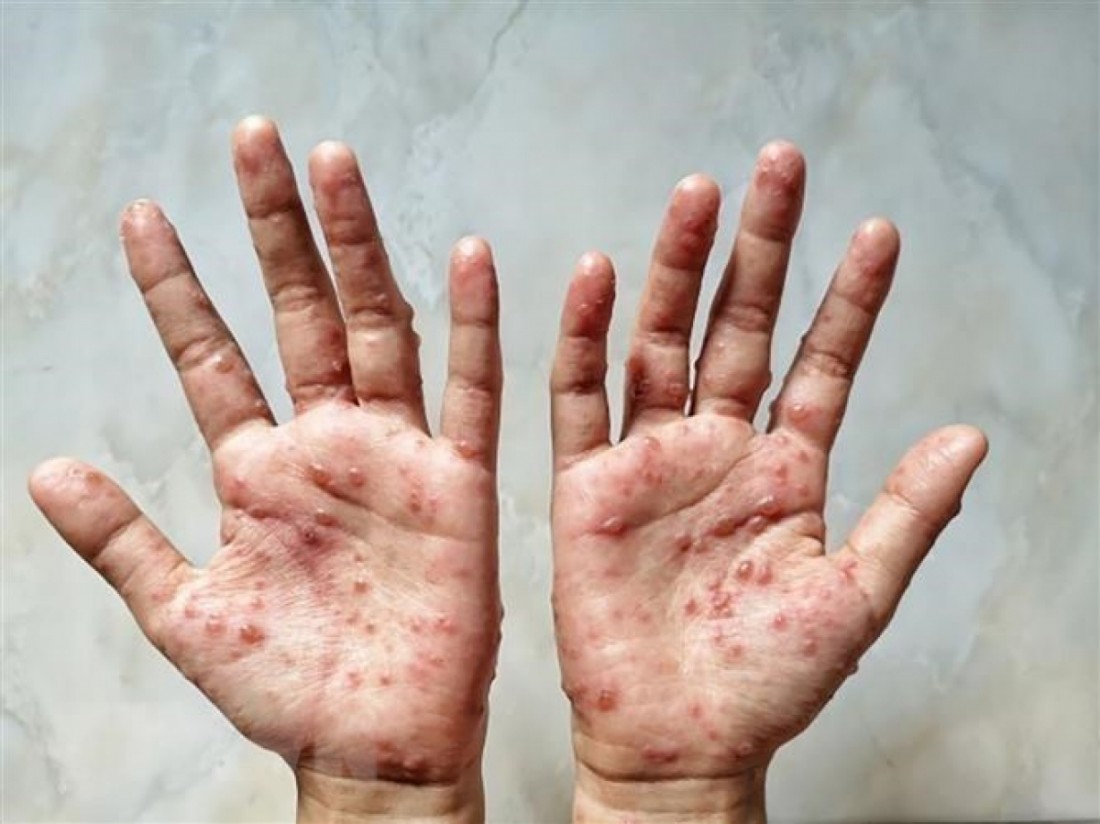 TP HCM ghi nhận ca nhiễm đậu mùa khỉ đầu tiên. 
