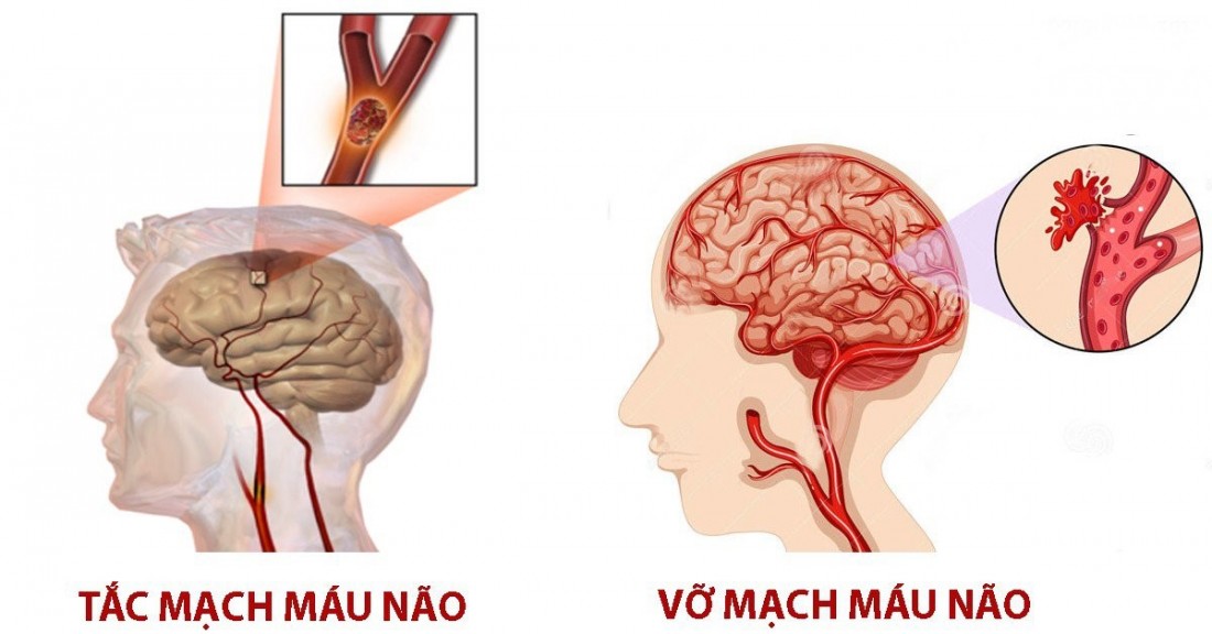Nguyên nhân gây đột quỵ não là do sự bất ổn của tuần hoàn máu não. Ảnh minh họa