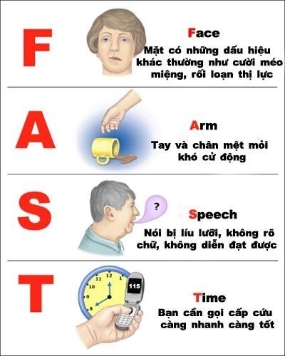 Các dấu hiệu nhận biết đột quỵ não từ sớm.