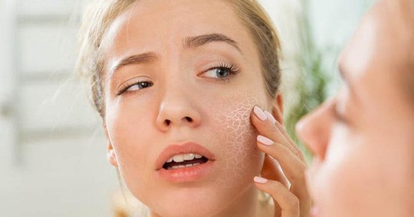 Vào mùa hanh khô nhiều người thường gặp tình trạng da nứt nẻ... Ảnh minh họa