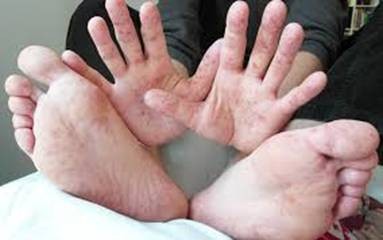 TP HCM: Số ca mắc bệnh sốt xuất huyết, tay chân miệng ở trẻ gia tăng