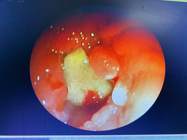 Mảnh xương heo dài 1,5cm nằm trong phế quản nữ bệnh nhân Đ.T.H hơn 1 tháng...