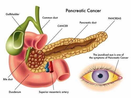 Ung thư tuyến tụy là một trong những loại ung thư đường tiêu hóa nguy hiểm.