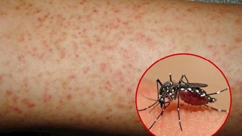 Sốt xuất huyết Dengue là bệnh truyền nhiễm cấp tính do virus Dengue gây ra.