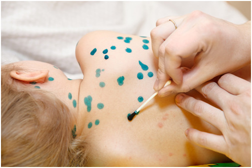 Cha mẹ nên cho trẻ tiêm phòng vaccine để ngăn ngừa bệnh thủy đậu.