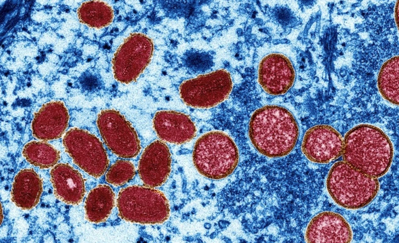Virus đậu mùa khỉ gây ra các triệu chứng tương tự cúm. Ảnh: CDC