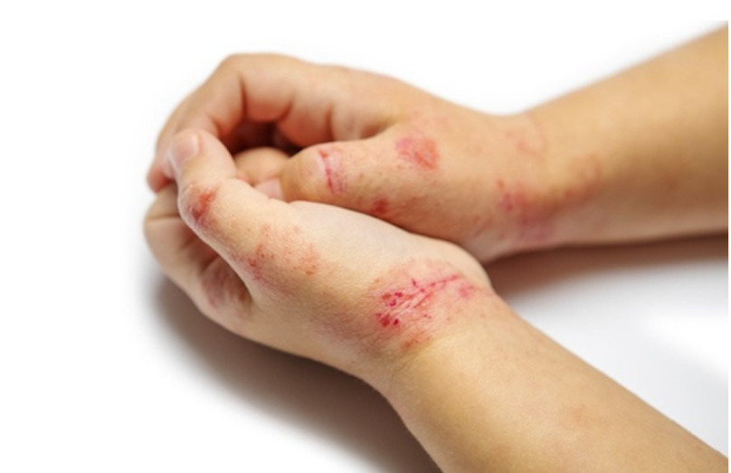 Những tổn thương do chốc lở có thể lan từ vùng da này sang vùng da khác trên cơ thể trẻ.