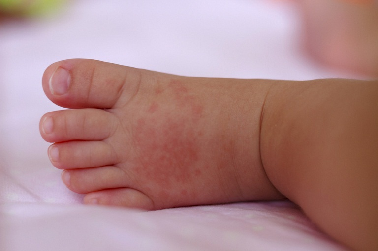 Sẩn ngứa là một trong những bệnh về da thường gặp ở trẻ nhỏ.