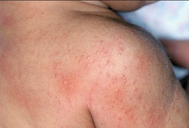 Phát ban nhiệt thường xuất hiện trên da khi cơ thể bé quá nóng.