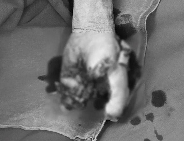 Bàn tay của bệnh nhân bị dập nát do điện thoại phát nổ. (Ảnh: PV/Vietnam+)