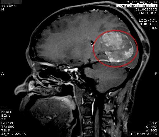 Hình ảnh bệnh nhân có khối u lớn trong não. Ảnh minh họa