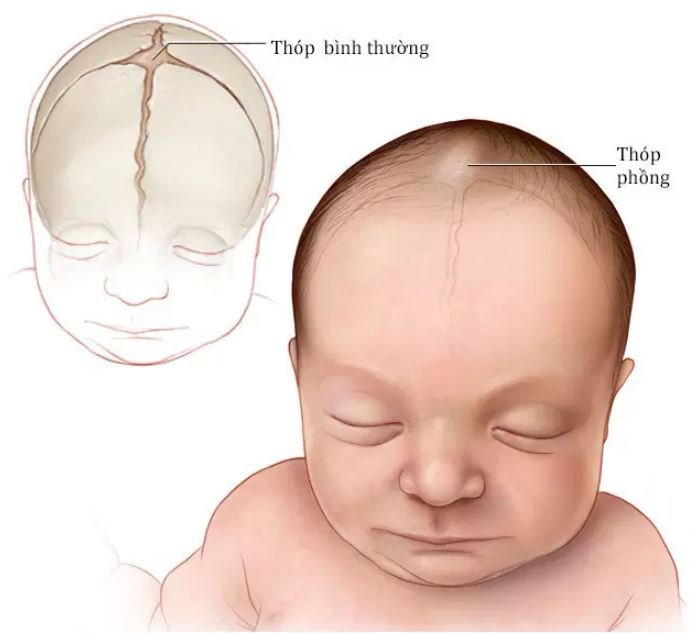 Khi thấy thóp trẻ có dấu hiệu phồng căng, cha mẹ cần lưu ý xem trẻ có mắc viêm màng não sơ sinh hay không? Ảnh minh họa