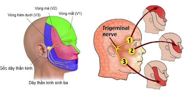Hội chứng Ramsay Hunt là tình trạng xảy ra trong những trường hợp bệnh có biểu hiện liệt dây thần kinh mặt ngoại biên, kèm theo dấu hiệu nổi ban đỏ, mụn nước ở tai hoặc ở miệng.