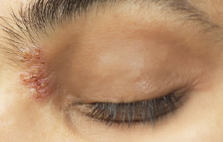 Biến chứng ở vùng mắt của người bệnh là một trong những tình trạng phổ biến khi bị mắc zona thần kinh.