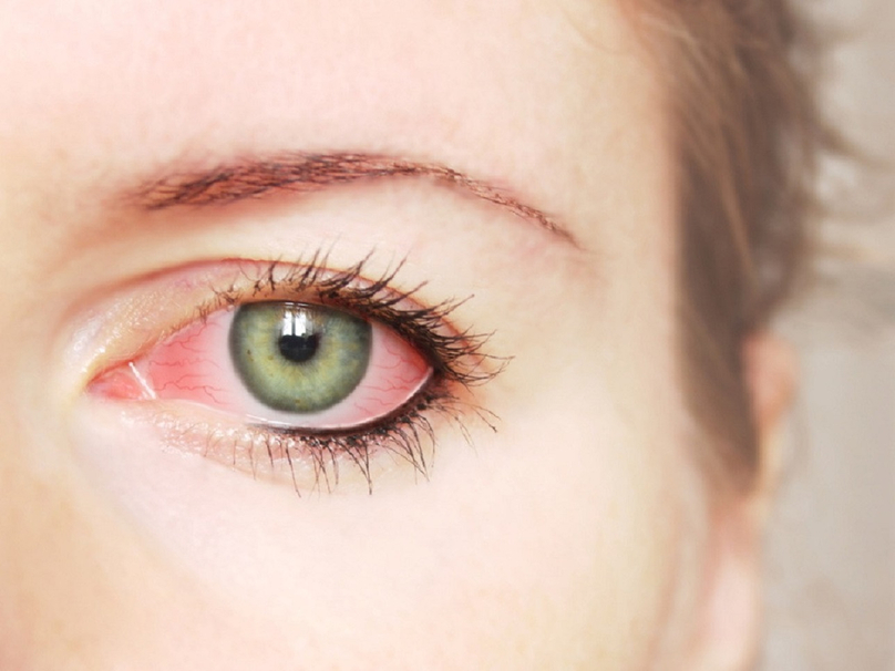 Đau mắt đỏ (viêm kết mạc) là tình trạng nhiễm trùng mắt thường gặp do vi khuẩn hoặc virus gây ra.