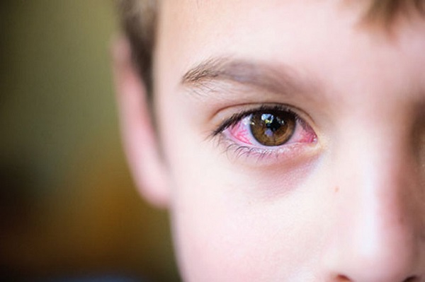 Đau mắt đỏ rất dễ lây lan, vì vậy mọi người cần chủ động phòng tránh, bảo vệ đôi mắt của mình.