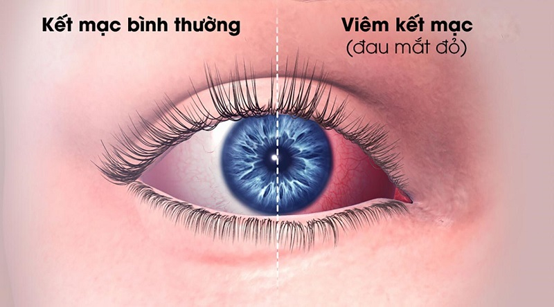Đau mắt đỏ là bệnh dễ lây nhưng thường lành tính và ít để lại di chứng nguy hiểm nếu được điều trị kịp thời.