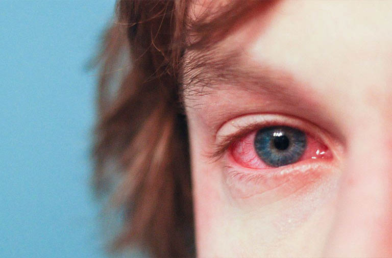 Người đau mắt đỏ nên chọn cho mình một chế độ dinh dưỡng phù hợp để bệnh nhanh được cải thiện.