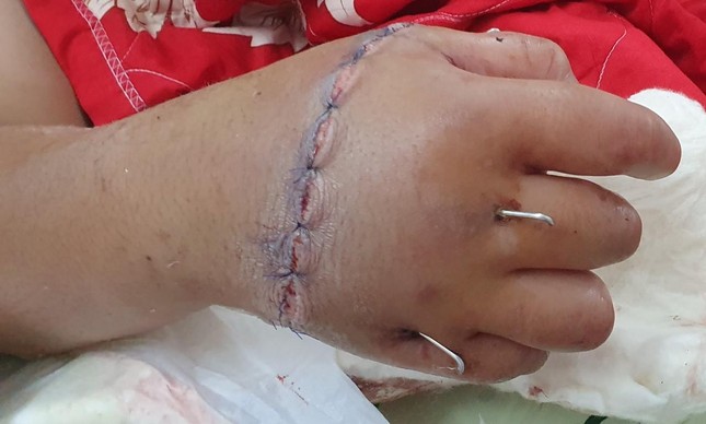 Sau 10 ngày phẫu thuật, bàn tay của bệnh nhân đã sống hoàn toàn, các ngón cử động tốt.