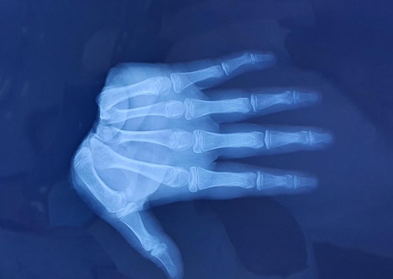 Hình ảnh kiểm tra bàn tay đứt lìa của bệnh nhân trước khi thực hiện vi phẫu.