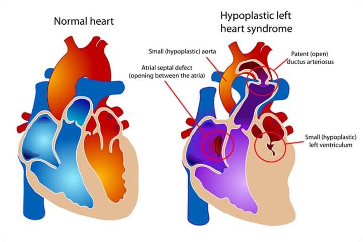 Hình ảnh tim bình thường và tim bị giảm sản tim trái. Bệnh xảy ra khi trẻ phát triển trong thời kỳ bào thai, tim trái không được hình thành đúng cách.