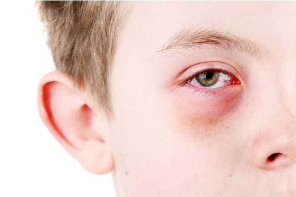 Người đau mắt đỏ nên đến các cơ sở y tế để được chẩn đoán và điệu trị kịp thời, tránh các biến chứng nguy hiểm.