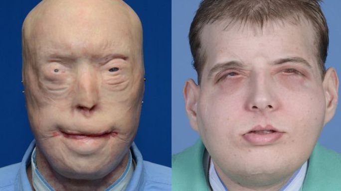 Patrick Hardison trước và sau khi ghép mặt. Ảnh: BBC