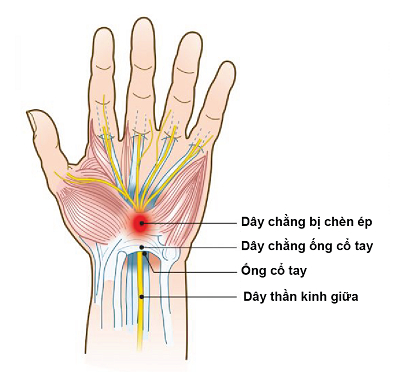 Hội chứng ống cổ tay là tình trạng bệnh lý chèn ép dây thần kinh ngoại biên hay gặp nhất.