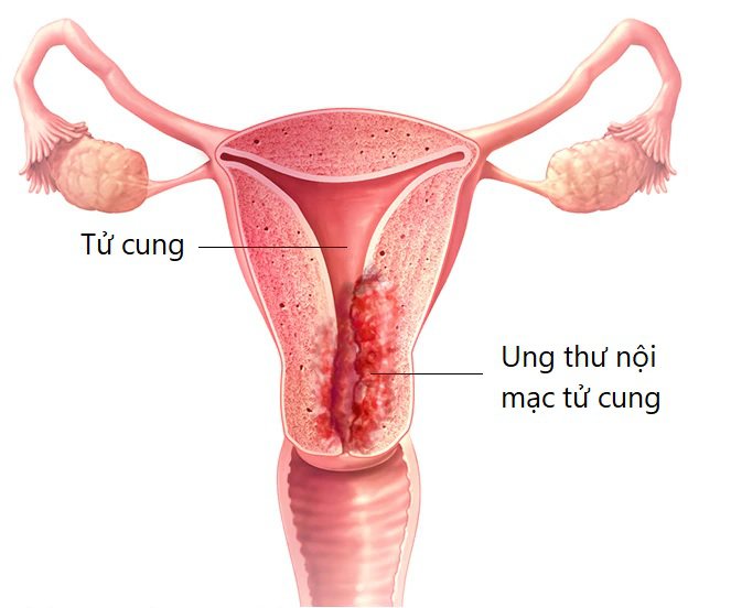 Ung thư nội mạc tử cung thường gặp trong số các bệnh lý ung thư ở nữ giới.