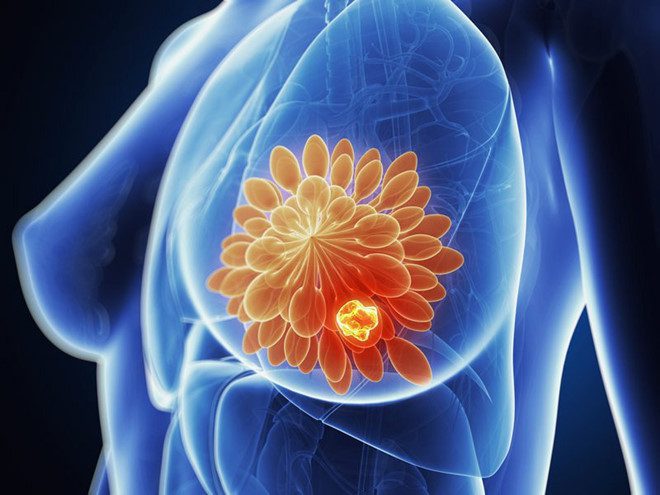 Ung thư vú có thể xuất hiện ở mọi lứa tuổi, nhưng nguy cơ mắc bệnh tăng theo tuổi.