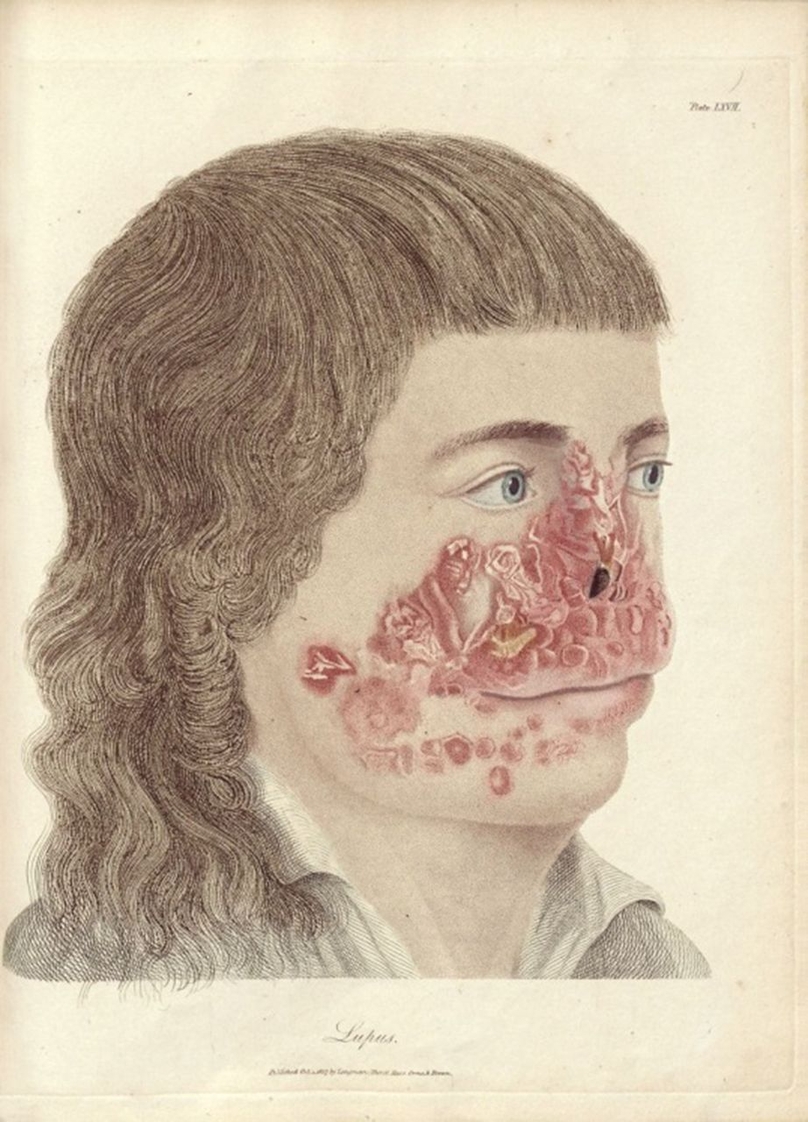 Hình ảnh minh họa đầu tiên về bệnh lupus ban đỏ trong cuốn sách các bệnh về da.