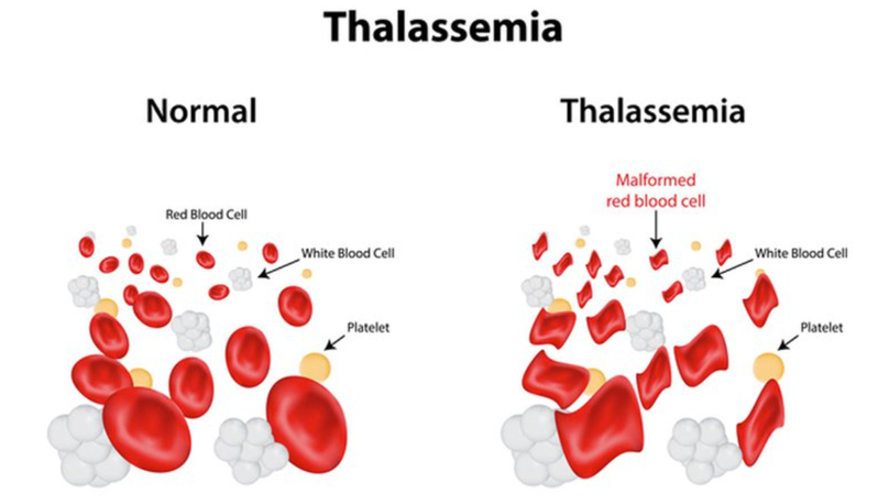 Thalassemia (còn được gọi là bệnh tan máu bẩm sinh) là một bệnh lý huyết học di truyền liên quan đến sự bất thường của hemoglobin.