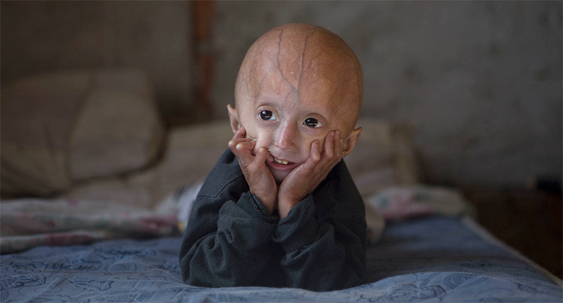 Hội chứng Progeria – những điều chưa biết về căn bệnh lão hóa sớm ở trẻ