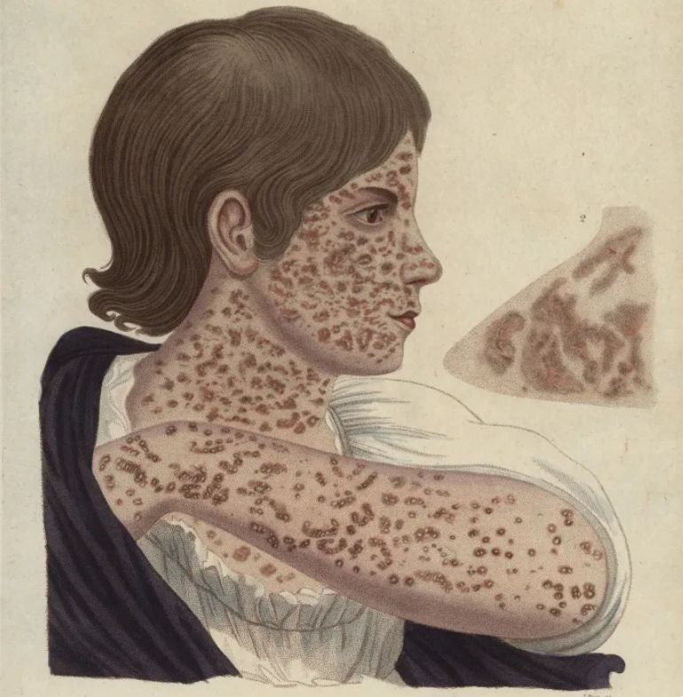 Một hình minh họa năm 1822 mô tả các triệu chứng của bệnh sởi.