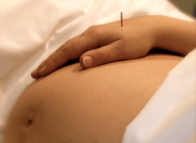 Châm cứu có thể làm giảm đáng kể tình trạng đau lưng dưới hoặc đau vùng chậu mà phụ nữ thường gặp phải khi mang thai (ảnh minh hoạ).