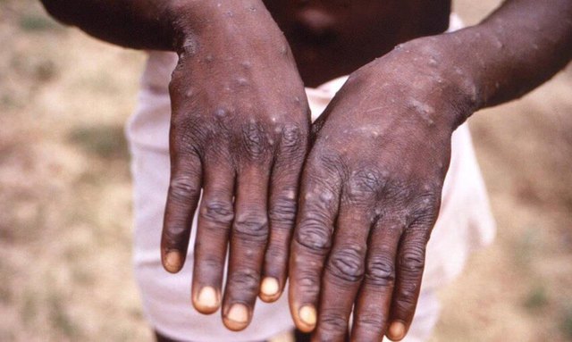  Tổn thương da tay ở bệnh nhân bị bệnh đậu mùa khỉ.