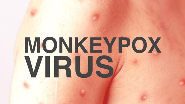  Bệnh đậu mùa khỉ có thể lây lan khi tiếp xúc da kề da khi quan hệ tình dục.