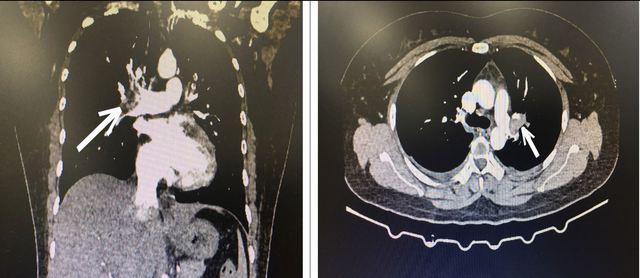  Hình ảnh CT lồng ngực bệnh nhân bị tắc động mạch phổi cấp tính.