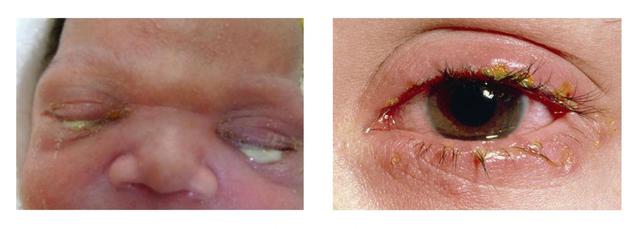  Lậu mắt ở trẻ sơ sinh 3 ngày tuổi (ảnh trái). Lậu mắt bệnh nhân nữ (Ảnh phải).