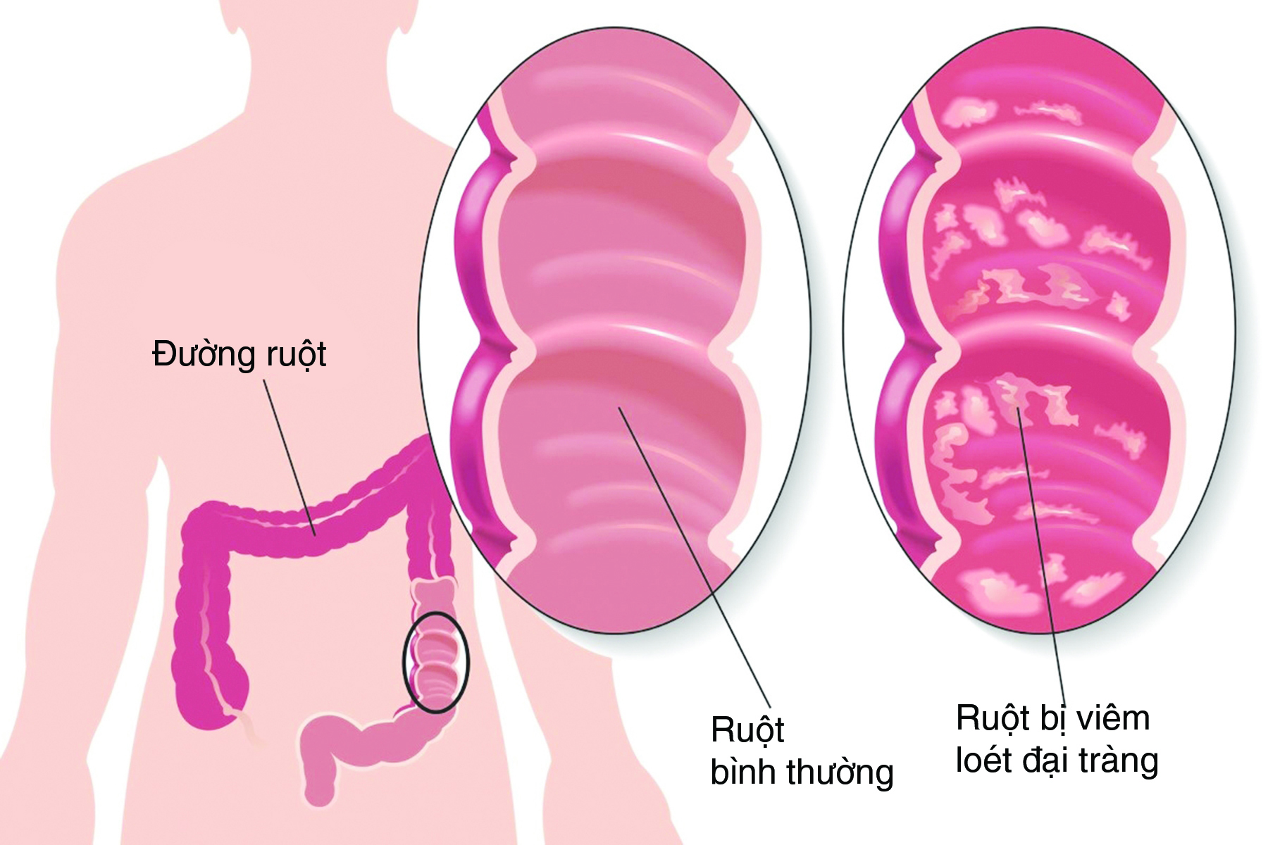 Liệu pháp mới hiệu quả chữa viêm loét đại tràng