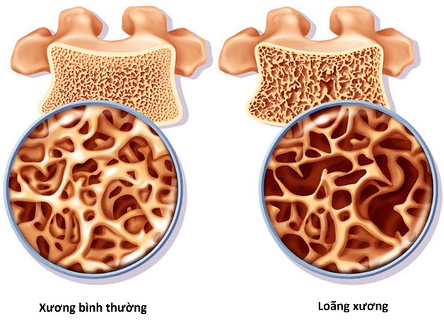 Cách nhận biết thiếu canxi và thời điểm nên bổ sung