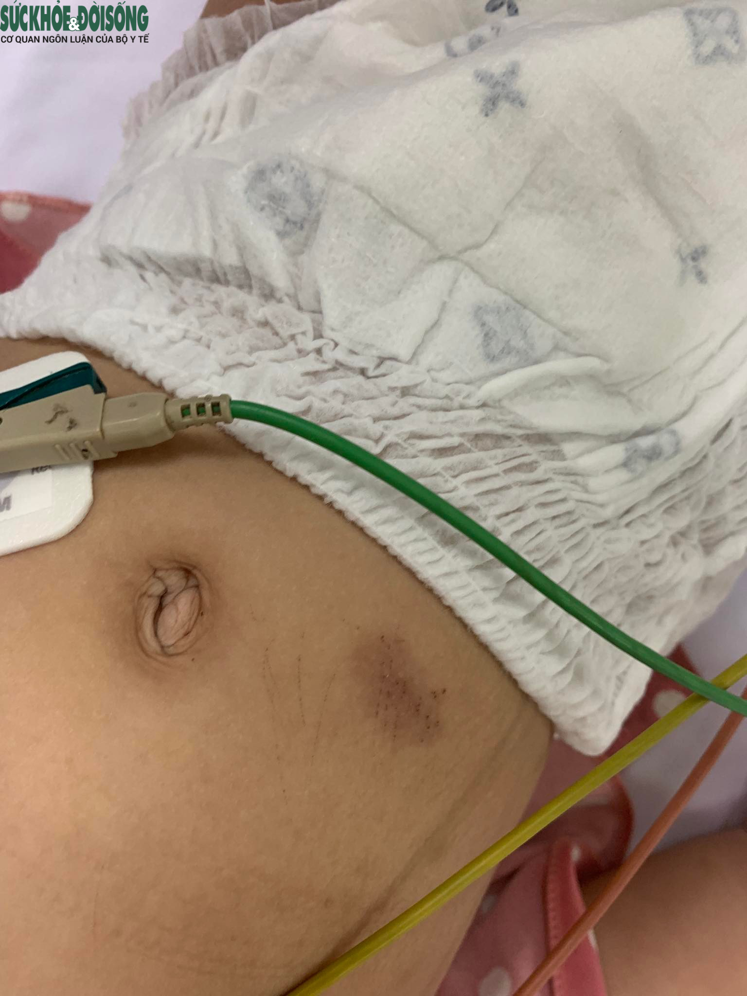 Bé gái 18 tháng tuổi nhập viện trong tình trạng sốt cao, trên người có nhiều vết lằn tổn thương da, nghi do bạo hành. Ảnh Bệnh viện cung cấp. 