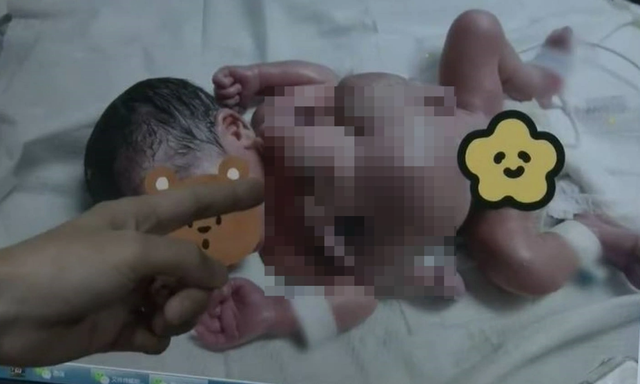  Bé trai sơ sinh ra đời có 4 tay 4 chân tại Trung Quốc. Ảnh: SCMP