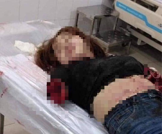 Nạn nhân bị chồng chém đứt 2 cánh tay, nhập viện cấp cứu. Ảnh: FB