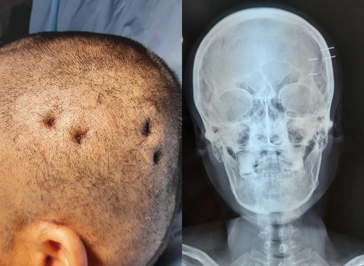 Ảnh chụp X-quang bốn cây đinh ghim vào hộp sọ.