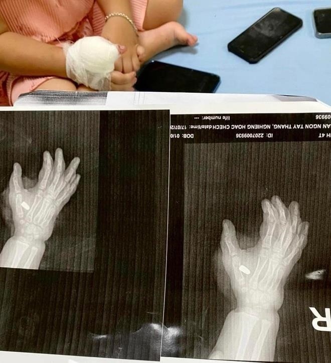 Hình ảnh viên đạn nằm trong tay của cháu bé 4 tuổi (Ảnh: Công an TP Thanh Hóa)