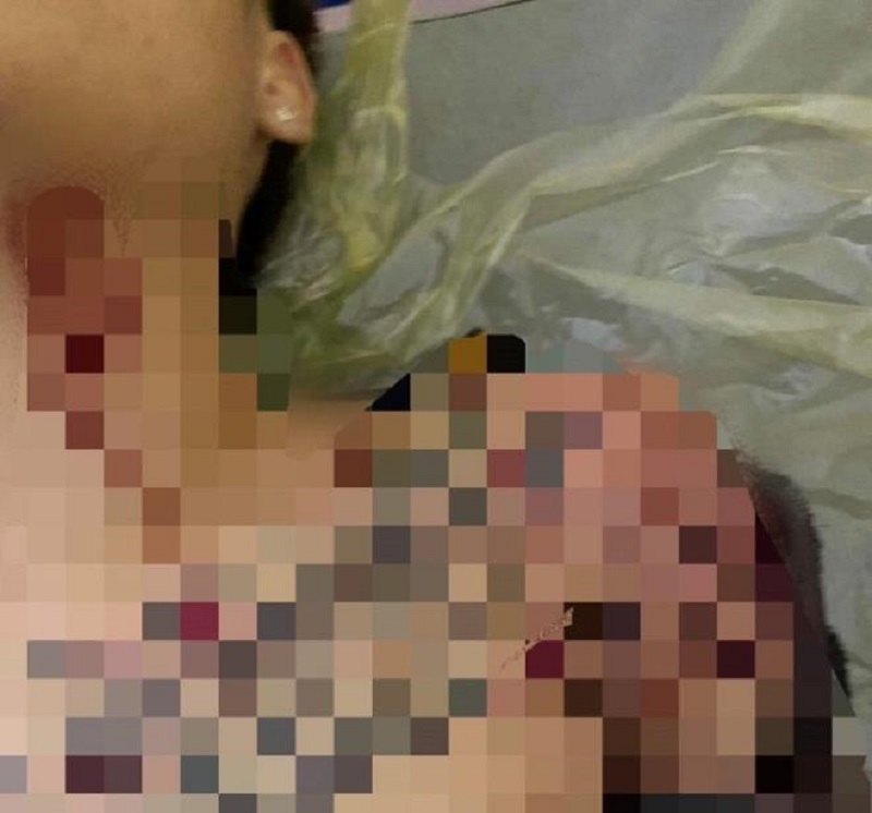 Nạn nhân vụ nổ súng gần Trạm thu phí BOT Thanh Nê - Thái Bình bị nhiều mảnh đạn găm vào phổi và tim, hiện đang được cấp cứu tại tại Bệnh viện Hữu nghị Việt Đức. (Ảnh: Gia đình nạn nhân cung cấp).