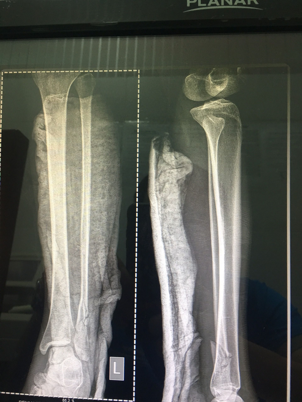 Hình chụp xương tay, xương chân của chị M. bị gãy. (Ảnh: Dân Trí).