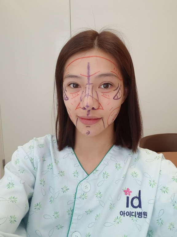 Gương mặt cô trước khi phẫu thuật được các bác sĩ vẽ lên chi chít. 