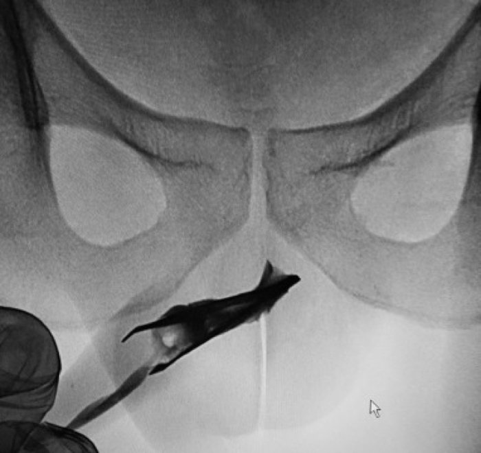 Kết quả chụp X-quang xác nhận chiếc nhíp dài tới 8 cm nằm ở niệu đạo trước.